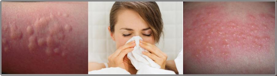 Аллергия - симптомы и лечение, признаки, причины и диагностика