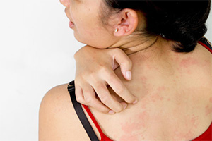 simptomy-allergii-kozha.jpg